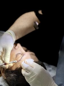 Thicker Brows with Eyebrow Transplant in Turkey