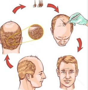 What is Donor Dominance?
