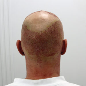 Can Donor Area Be Used Twice?