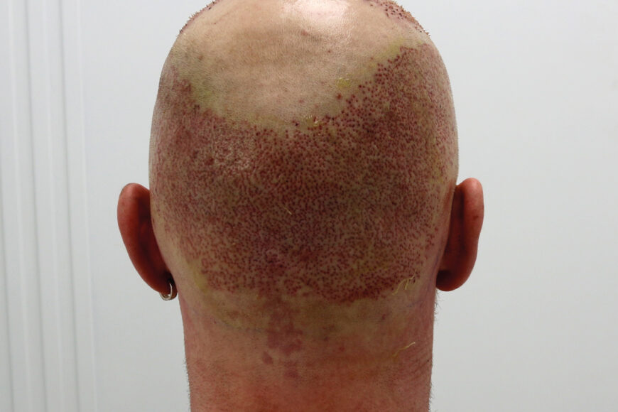 Can Donor Area Be Used Twice?