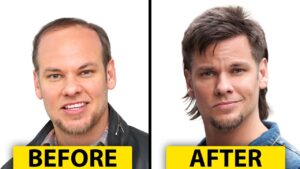 Did Theo Von Get a Hair Transplant