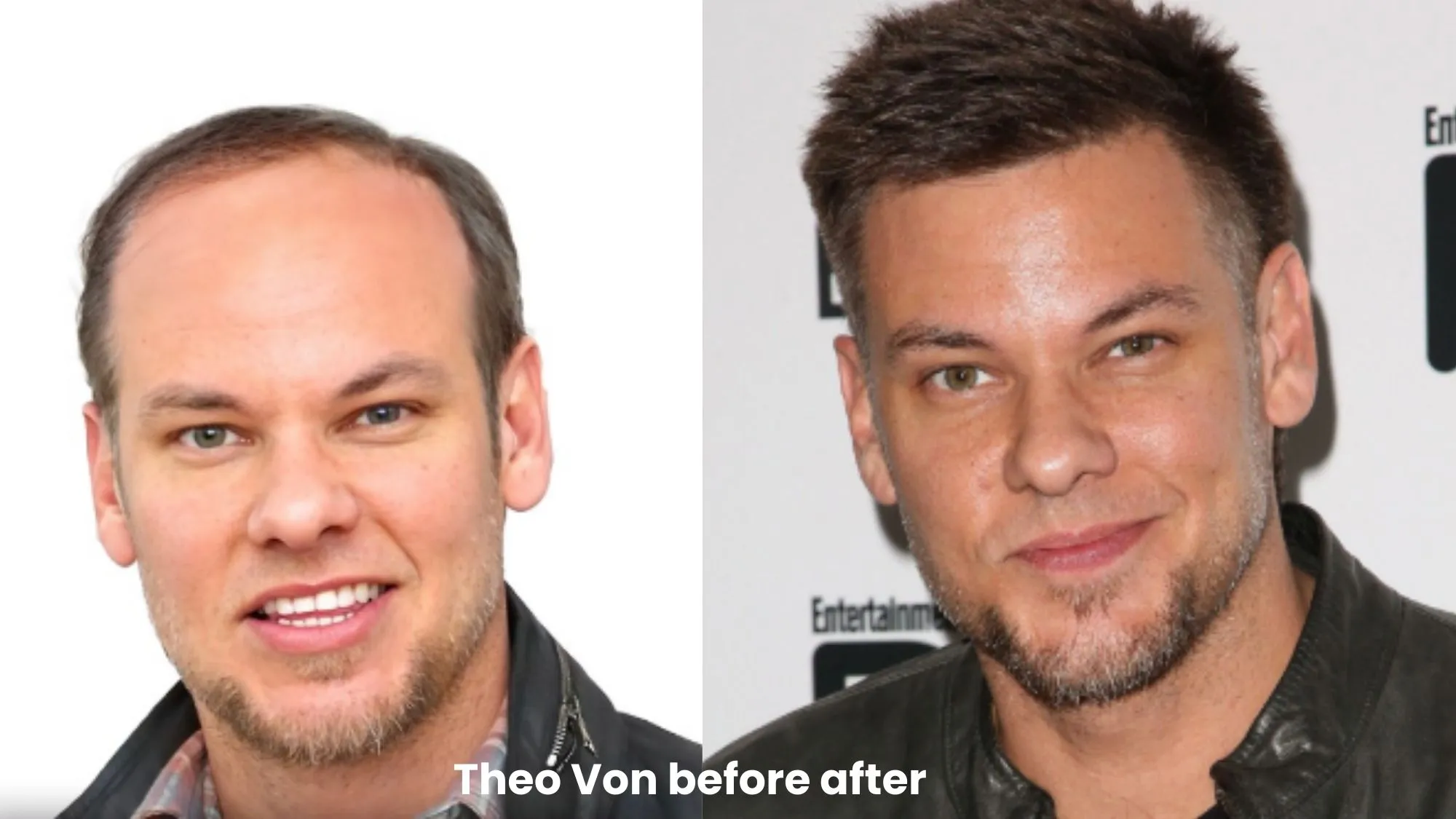 Did Theo Von Get A Hair Transplant