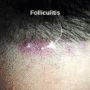 Understanding and Treating Folliculitis After a Hair Transplant