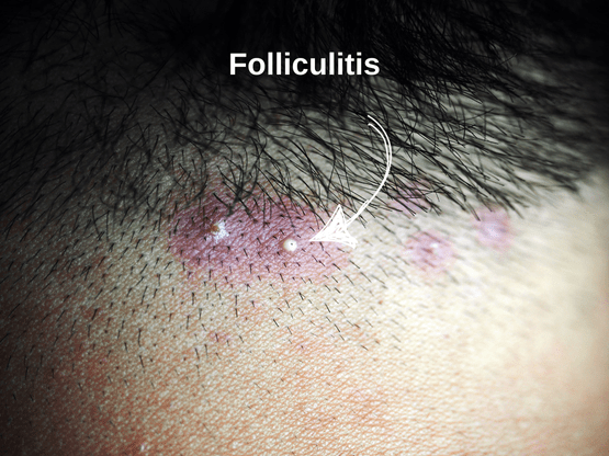 Understanding and Treating Folliculitis After a Hair Transplant