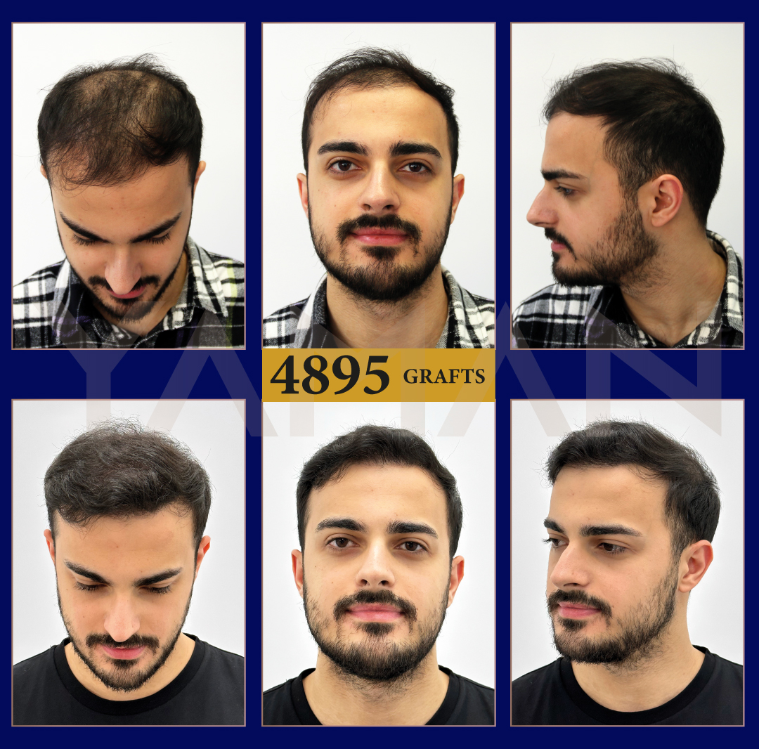 4895 grafts hair transplant result