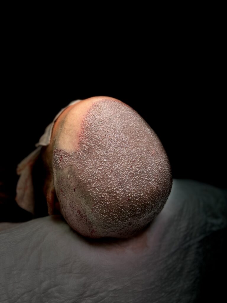 DHI Hair Transplant Turkey