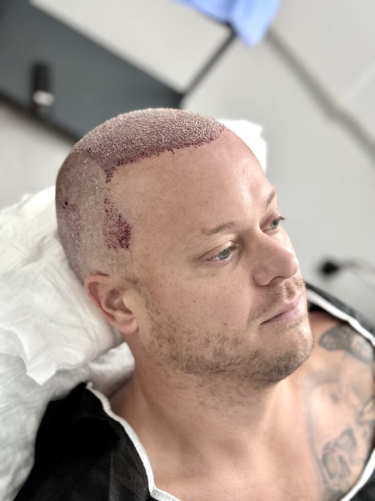 Recovery and Hair Growth Timeline