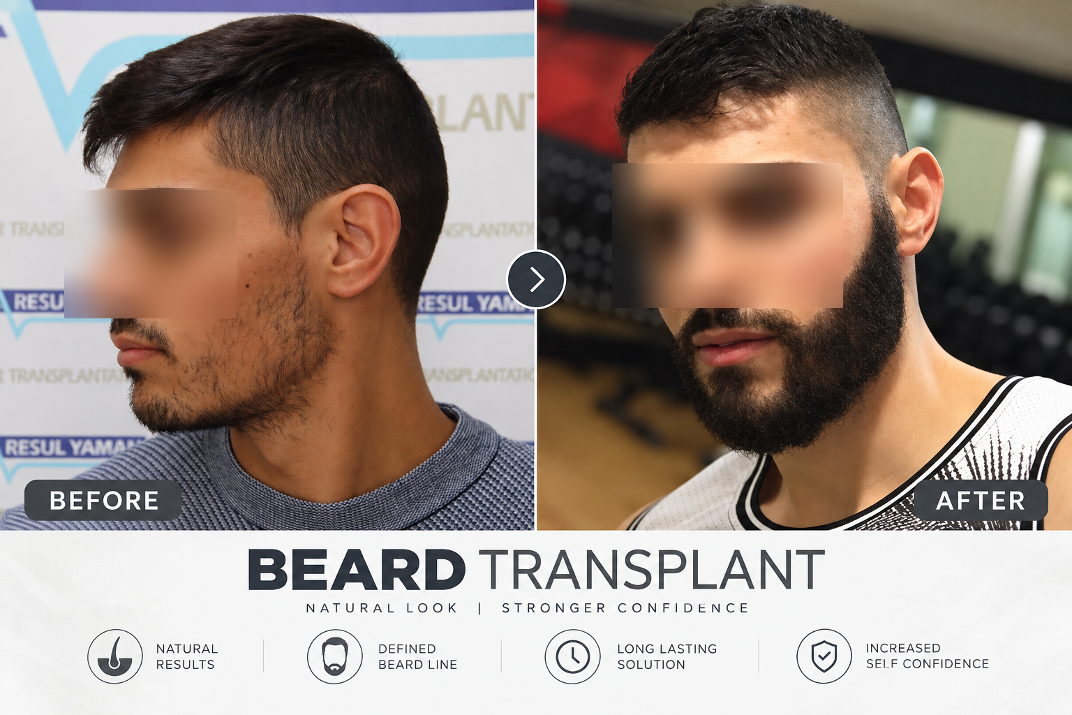 How is Beard Hair Transplant Performed