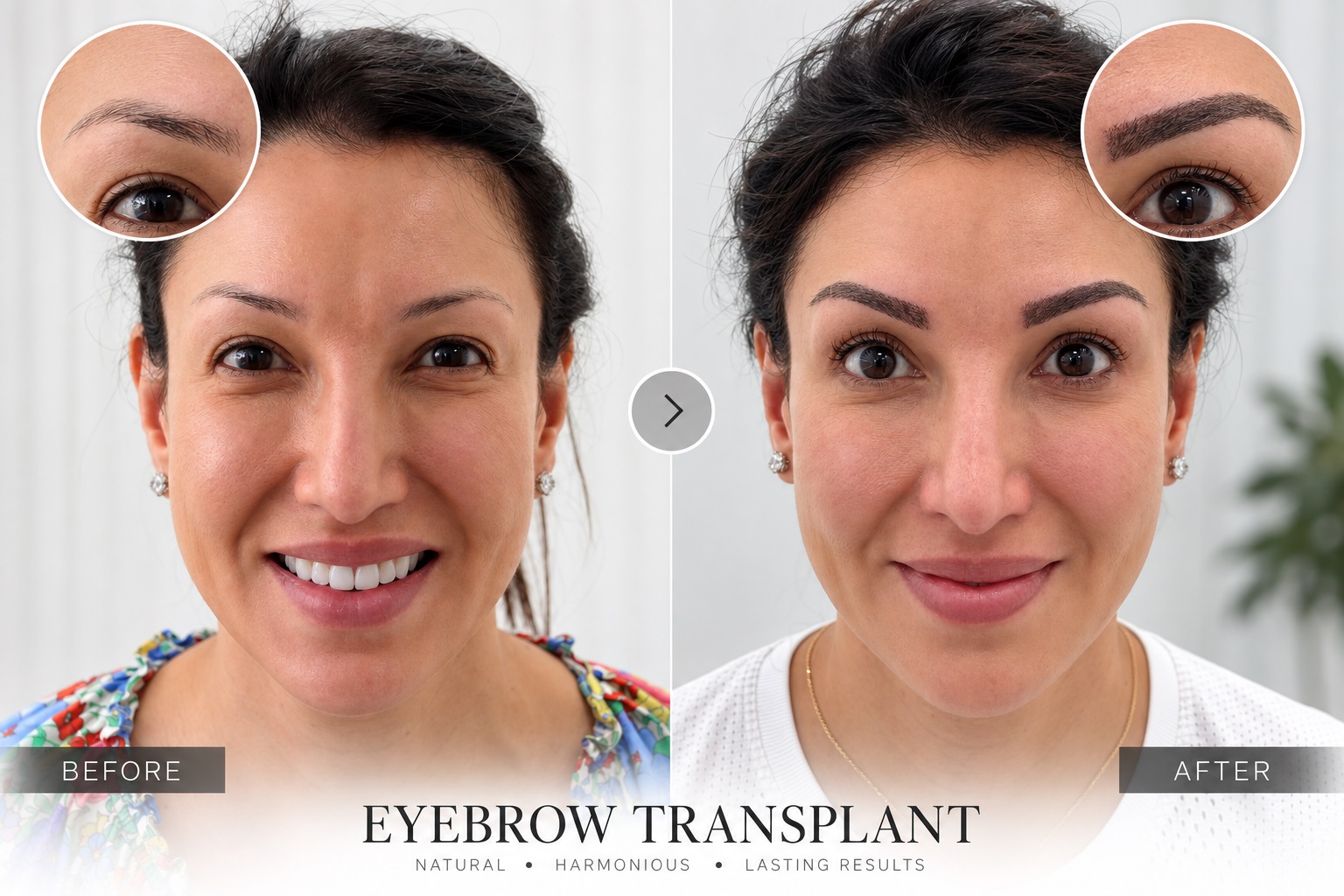 Eyebrow Transplant