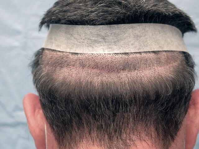 fut Unshaven Hair Transplant
