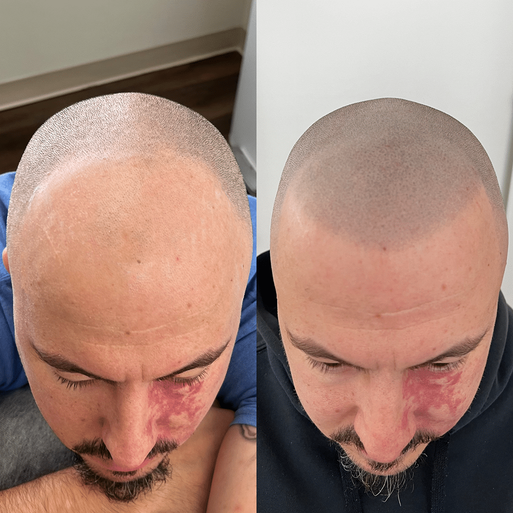 Comparación de micropigmentación capilar en la zona frontal y la línea capilar, con un aspecto más uniforme a la derecha.