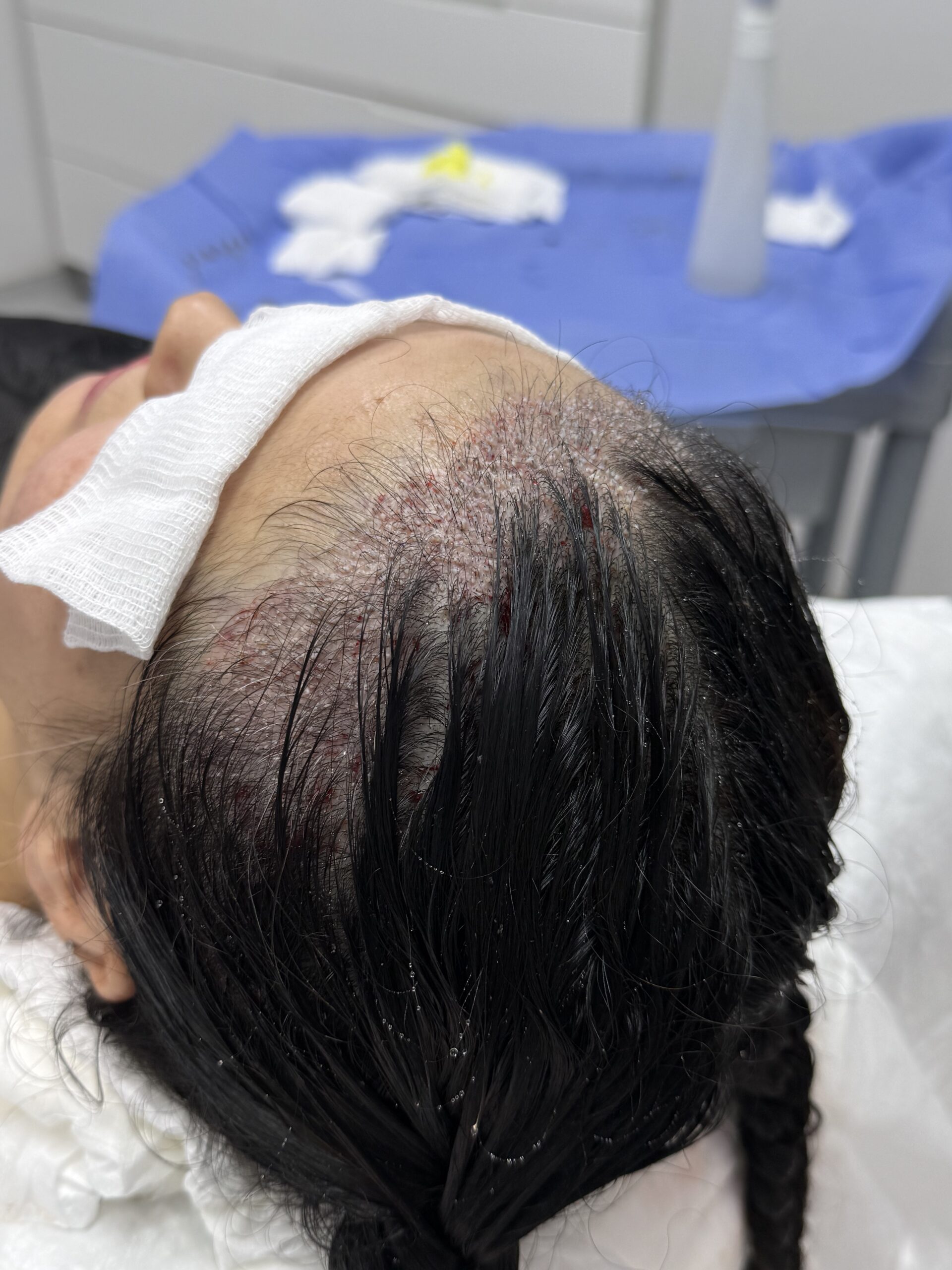Unshaven woman front Hair Transplant